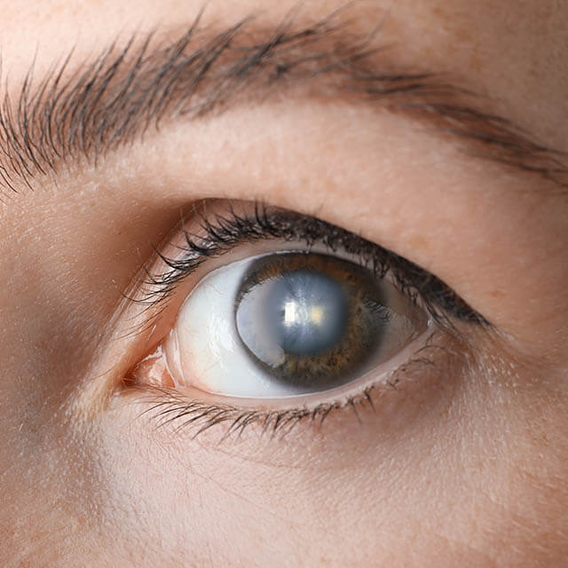 Closeup View Of Woman Suffering From Cataract