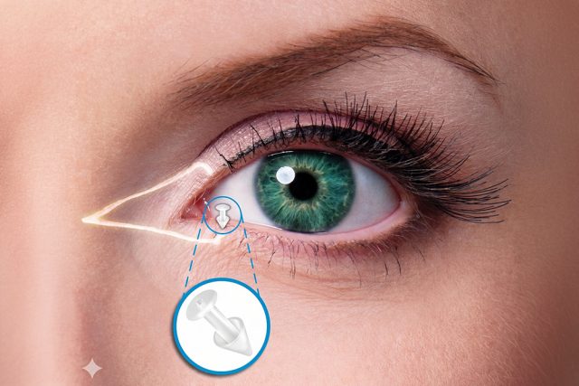 Close up of eye with graphic of punctal plug 640x427