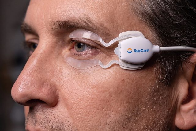 Man having TearCare treatment for Dry Eye relief 640x427