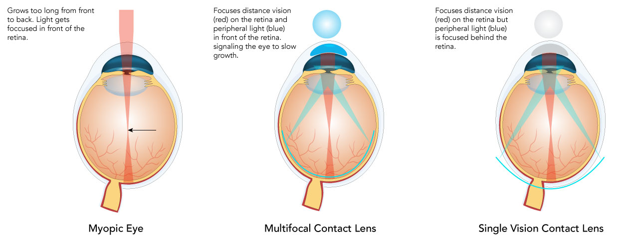 soft multifocal